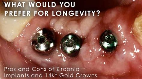 What would you prefer for Longevity? Pros and Cons of Zirconia Implants and 14Kt Gold Crowns ...