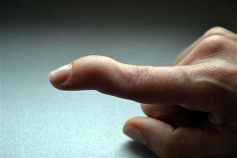 Mallet finger - Max Superspecialty Ortho Clinic