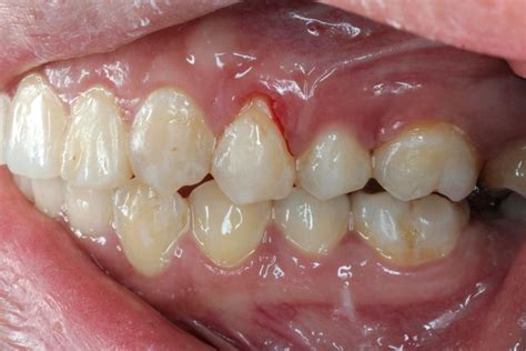 Gum recession - Causes, Treatment, Prevention and More