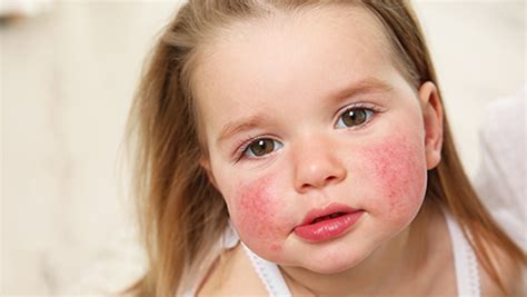 Food Allergy Rash On Face