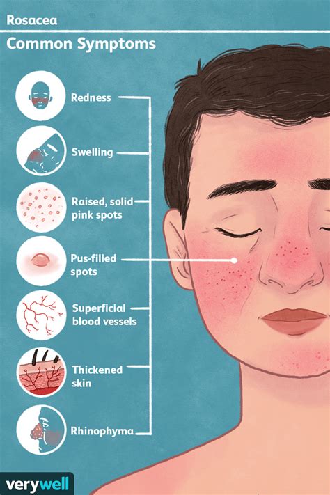 Rosacea: Signs, Symptoms, and Complications