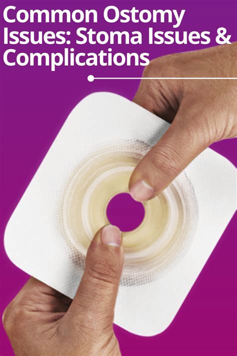 Understanding Stoma Issues: Common Ostomy Complications Explained