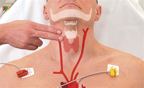 Carotid Sinus Massage | NEJM