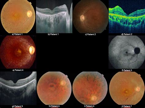 Retinitis Pigmentosa - Symptoms, Causes, & Treatment | Low Vision Aids