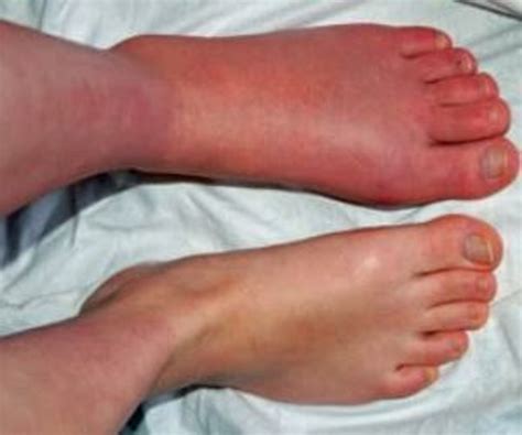 Complex Regional Pain Syndrome of Foot(CRPS) | Dr. Sampat Dumbre Patil | Dr. Sampat Dumbre Patil