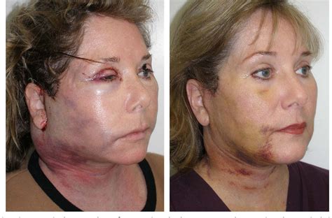 Figure 28 from Complications in facelift surgery and their prevention. | Semantic Scholar