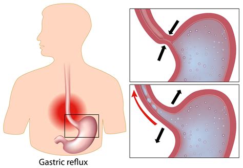 Gastro Esophageal Reflux Disease - Jackson Siegelbaum Gastroenterology