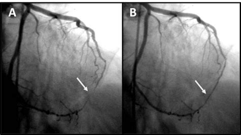 Coronary angiography of left coronary artery. Myocardial bridging of ...