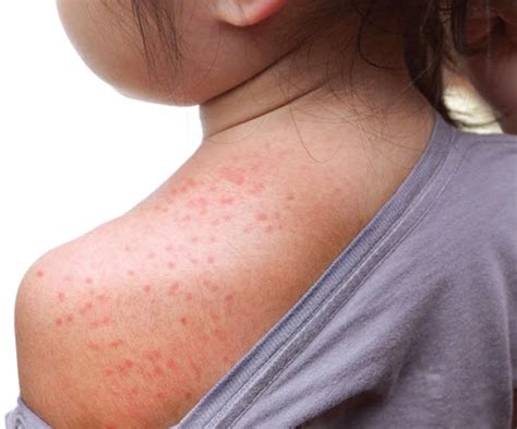 Use This Guide to Code Pediatric Skin Rashes : ICD-10 Coding