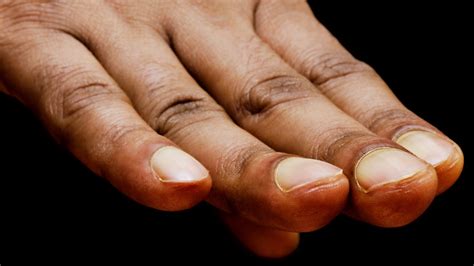 What It Means If You Have Clubbed Nails