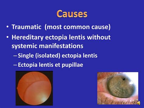 PPT - Ectopia Lentis PowerPoint Presentation, free download - ID:4912491