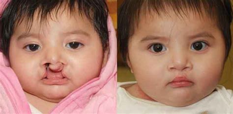 Cleft Palate as related to Regular Insulin - Pictures