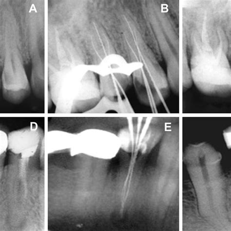 (PDF) Root-canal treatment of premolar teeth with complex anatomy