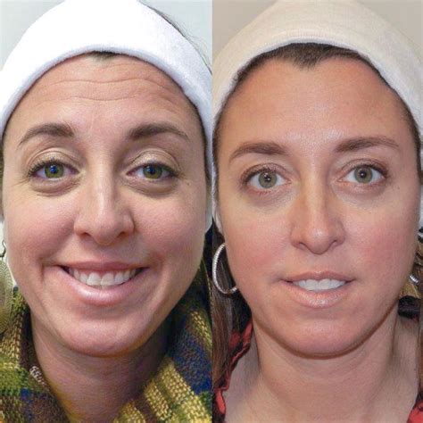 Botox Before And After Women Forehead