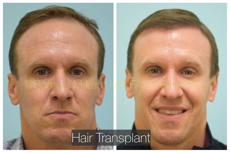 This 41-year-old man is shown before and six months after a hair transplant into his hairline ...