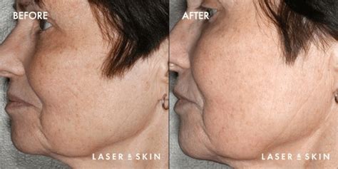 Thermage | Skin Tightening Treatment | Sacramento CA