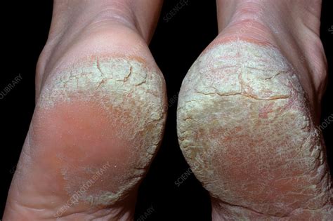 Details 126+ psoriasis cracked heels treatment latest - jtcvietnam.edu.vn