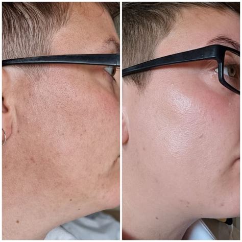 [Before&After] 3 Months Tretinoin : r/SkincareAddiction