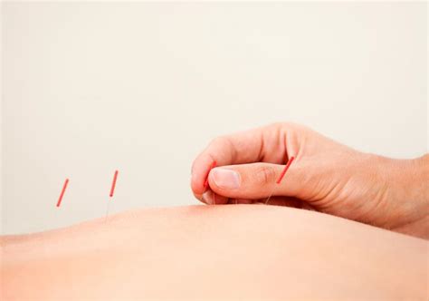 Benefits of Acupuncture Therapy- Oliver Chiropractic Wellness Clinic YEG