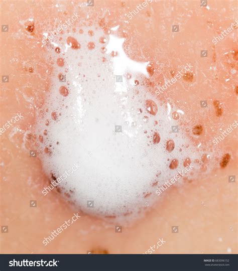 Wound On Human Skin Hydrogen Peroxide Stock Photo 683096152 | Shutterstock