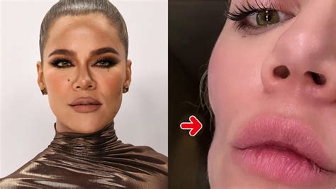 Khloe Kardashian Reveals Surprising Skin Procedure