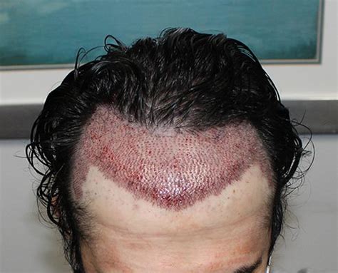 What to Expect During Hair Transplant Recovery