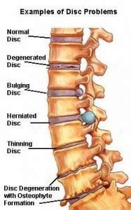 Spondylosis, Spondyloarthrosis | SpineTech