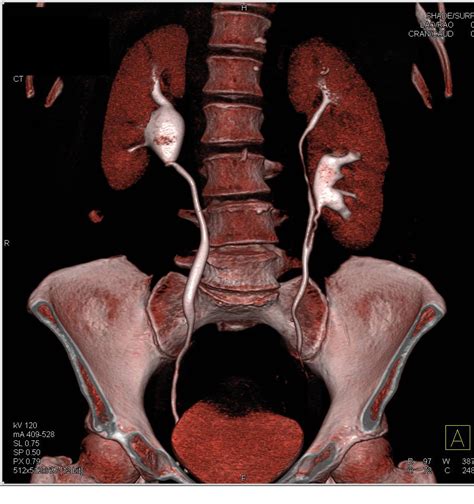 CT Urogram with Duplicated Collecting System on the Left - Kidney Case Studies - CTisus CT Scanning