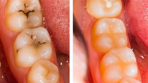 What Is A Composite Filling? - Magnolia Dental