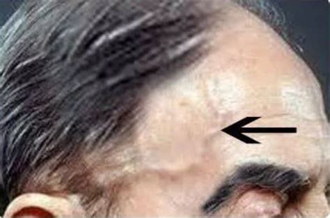 If you have a bulging veins on the forehead, here is what it means to ...