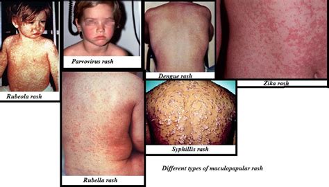 Maculopapular rash - Definition, Signs and Symptoms, Types, Causes, Treatments and Pictures ...