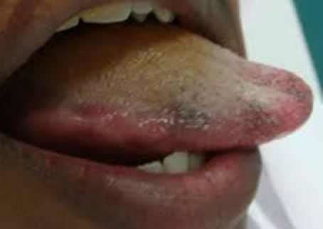 Black Spots on Tongue (Under, Side, Tip) Pictures & How to Remove Tiny Dark Dots – Treat n Heal