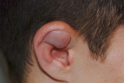 Boxer’s Ear: Can your ear explode? What is Auricular Hematoma or ...