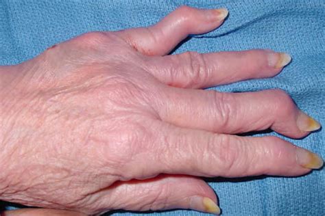 PSORIATIC ARTHRITIS | Hand Surgery Source