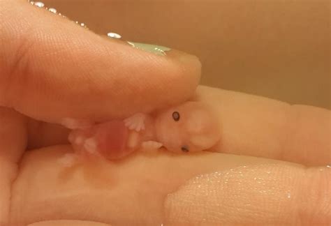 Incredible Photos of Babies Miscarried at 7 and 8 Weeks Prove the Humanity of Unborn Babies ...