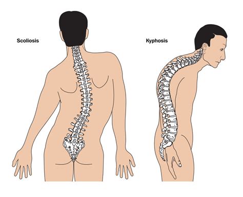 Cervical scoliosis