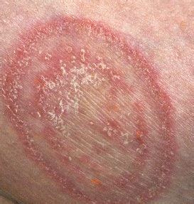 Armpit Rash on Underarm Skin - Pictures of Infection, Yeats, HIV