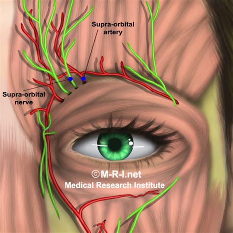 Supraorbital / Infraorbital nerve blocks for migraine – 6 months follow ...