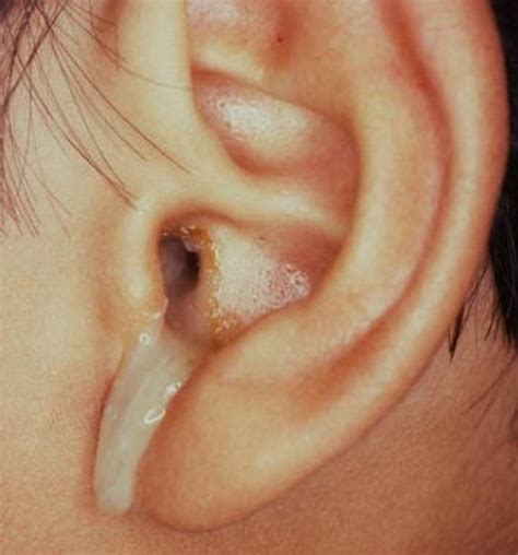 Infected Ear Drum