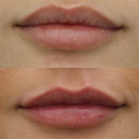 The Perfect Pair of Lips: Injections, Fillers, and Augmentation | VIDA