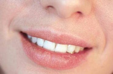 15 Best Home Remedies for Dry Lips - Home Remedies