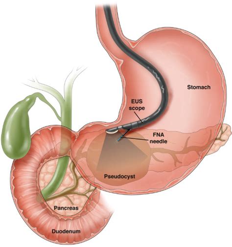 Endoscopic Retrograde Cholangio Pancreatography (ERCP) by Dr. Chairyu ...