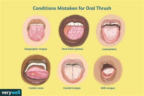 Normal Tongue vs. Oral Thrush and Other Conditions