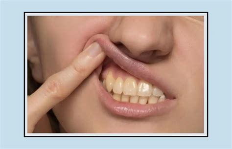 Overbite Vs Underbite - Causes and Treatment Options - Oral Health Line