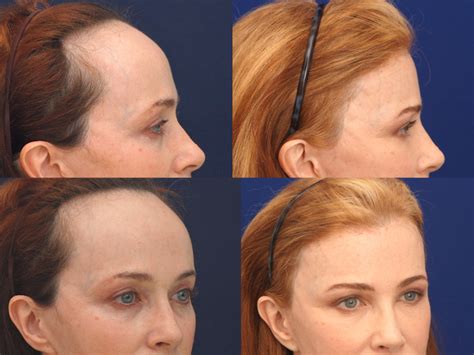 Forehead Reduction Surgery: Cost, Before and After Photos - Business ...