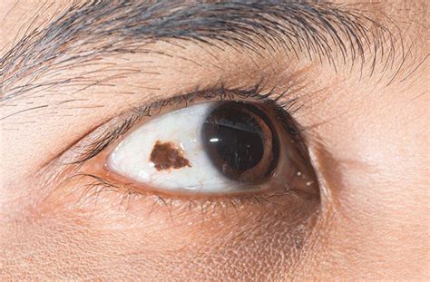 Conjunctival Nevus: Symptoms, Causes and Treatment