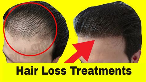 Top 5 Natural Hair Loss Treatment for Men – My Simple Remedies