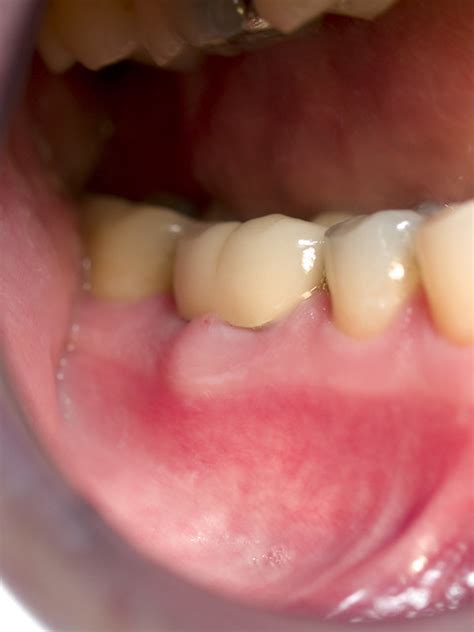 gingival abscess | Read about it in books, heard about it on… | Flickr ...