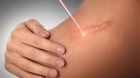 Treatments for Getting Rid of Scars | Alma Lasers