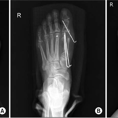 (A) Radiograph of 45-year-old female shows severe hallux valgus... | Download Scientific Diagram